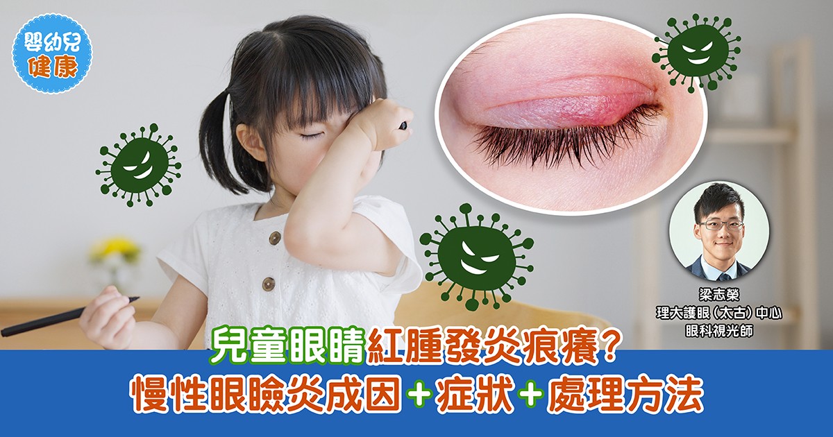 眼睛健康｜慢性眼瞼炎成因+症狀+處理方法 注意日常衛生 小心眼睛紅腫發炎