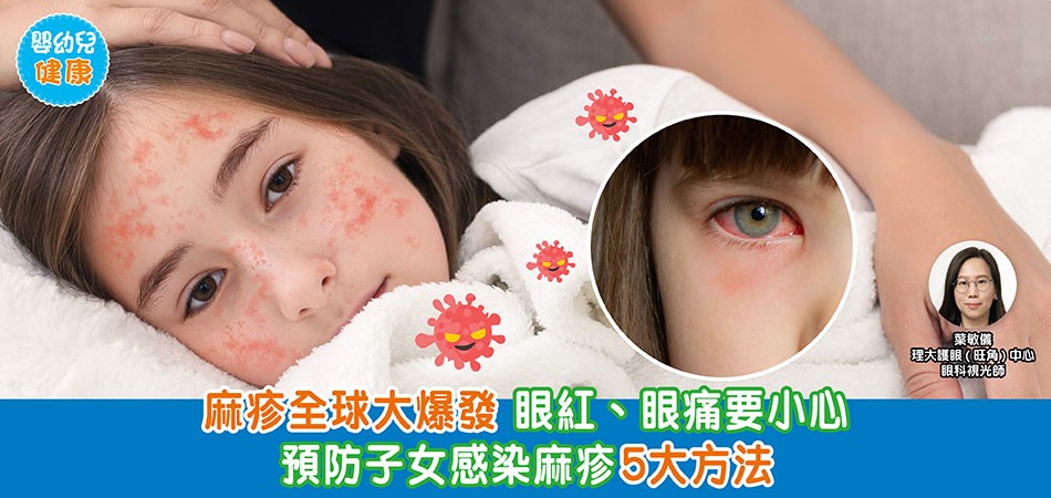 眼睛健康｜麻疹全球大爆發 眼紅、眼痛要小心 5大方法預防子女感染麻疹5大方法