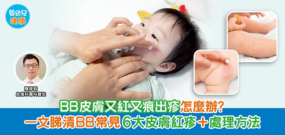 嬰幼兒健康｜BB皮膚又紅又痕出疹？怎麼辦？一文睇清BB常見6大皮膚紅疹+處理方法